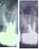 Il granuloma apicale: cosa e' e come curarlo